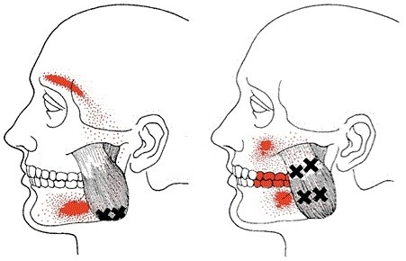 FISIOTERAPIA EN LA ARTICULACIÓN TEMPOROMANDIBULAR: MÚSCULO MASETERO