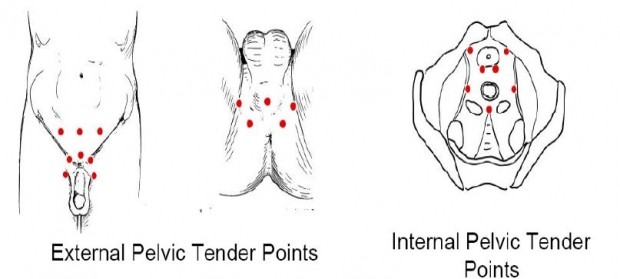 FISIOTERAPIA EN PROSTATITIS CRÓNICA