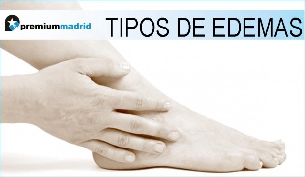Tipos de edemas y tratamiento con drenaje linfático manual