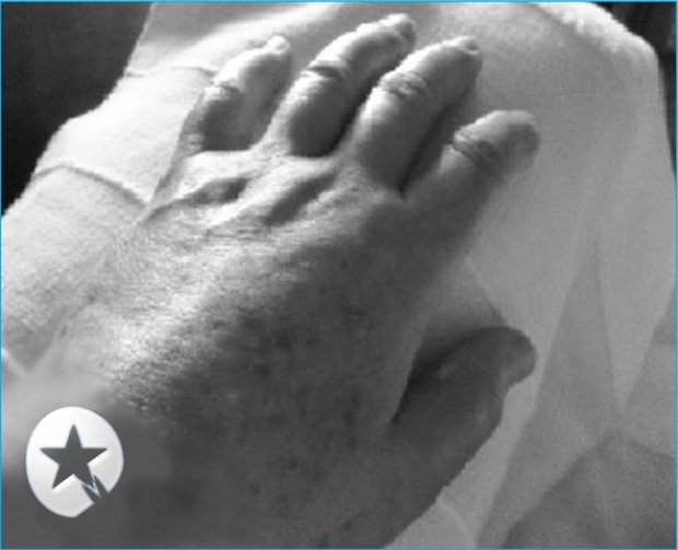 Caso Clínico: Edema postraumático