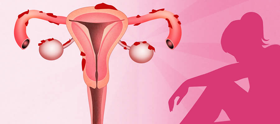 ¿Qué es la endometriosis? Causas, síntomas y tratamiento