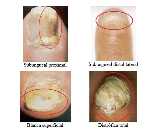 infeccion por hongos en las uñas: onicomicosis Premium Health & Sport infeccion-hongos-uñas-onicomicosis-Premium